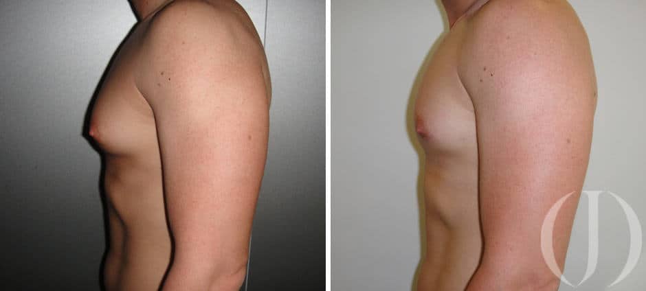 ginecomastia casos reales trans mastectomia masculinizacion del torax transgender