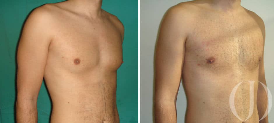 ginecomastia casos reales trans mastectomia masculinizacion del torax transgender