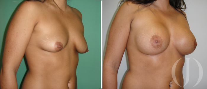 asimetria mamaria aumento de pecho barcelona