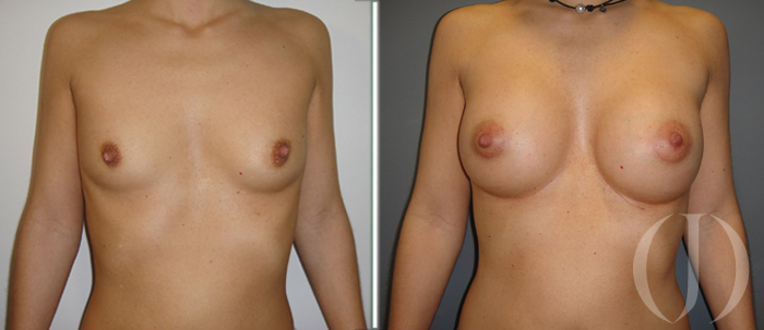 asimetria mamaria aumento de pecho barcelona