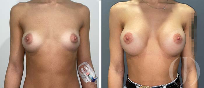 mamas tuberosas dr junco cirugia plastica aumento de pecho