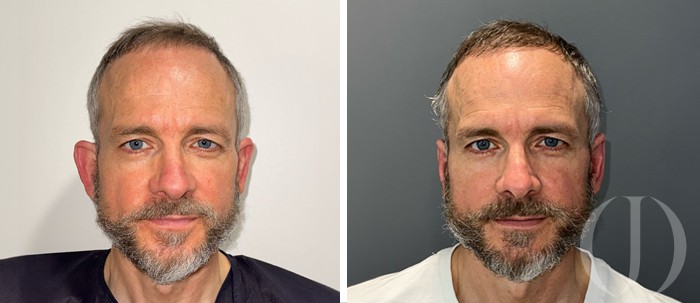 antes y después de cirugía de orejas de soplillo en barcelona por el doctor junco otoplastia