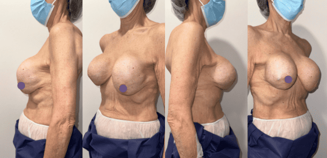 Las contracturas capsulares son un fenómeno que puede afectar a mujeres que han optado por la cirugía mamaria mediante implantes, a corto o largo plazo, con una probabilidad realmente baja. Estas contracturas se refieren a la formación exagerada de tejido cicatricial alrededor de la prótesis, creando una especie de "cápsula" consistente que rodea el implante mamario. Aunque esta respuesta del cuerpo es normal en cierta medida (cápsula fina), en algunos casos, puede volverse problemática (cápsula gruesa) cirujano plástico en barcelona aumento de pecho