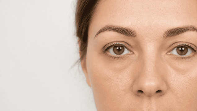 ¿Bolsas, ojeras oscuras o surco lagrimal? El Dr. Junco explica sus diferencias, sus causas y por qué cada caso necesita un tratamiento distinto.